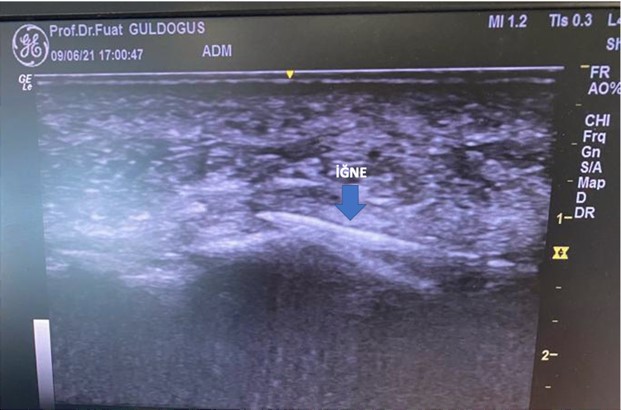 Ozon Uygulamalarında Ultrasonografi ve Skopi Kullanımı