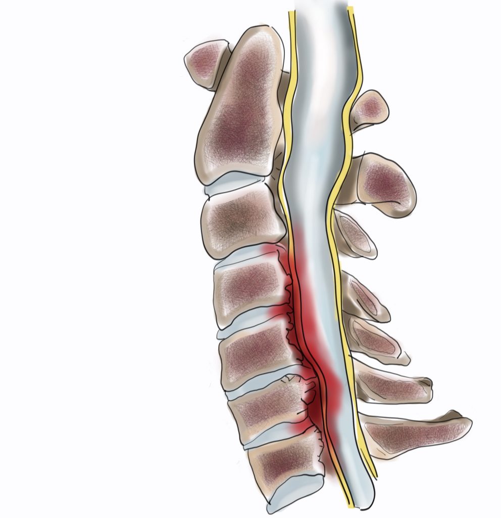 Boyun Omur Kanal Darlığı